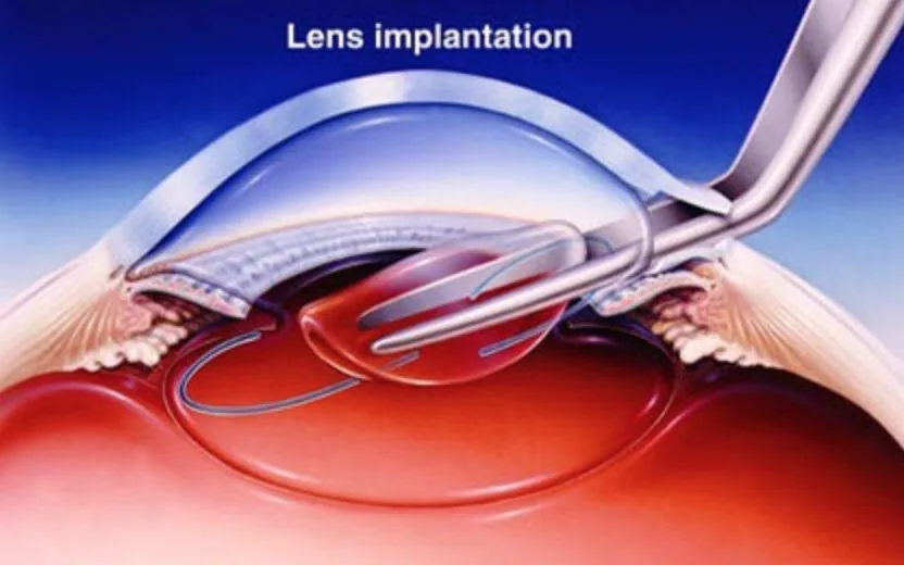 Is cataract surgery so simple?